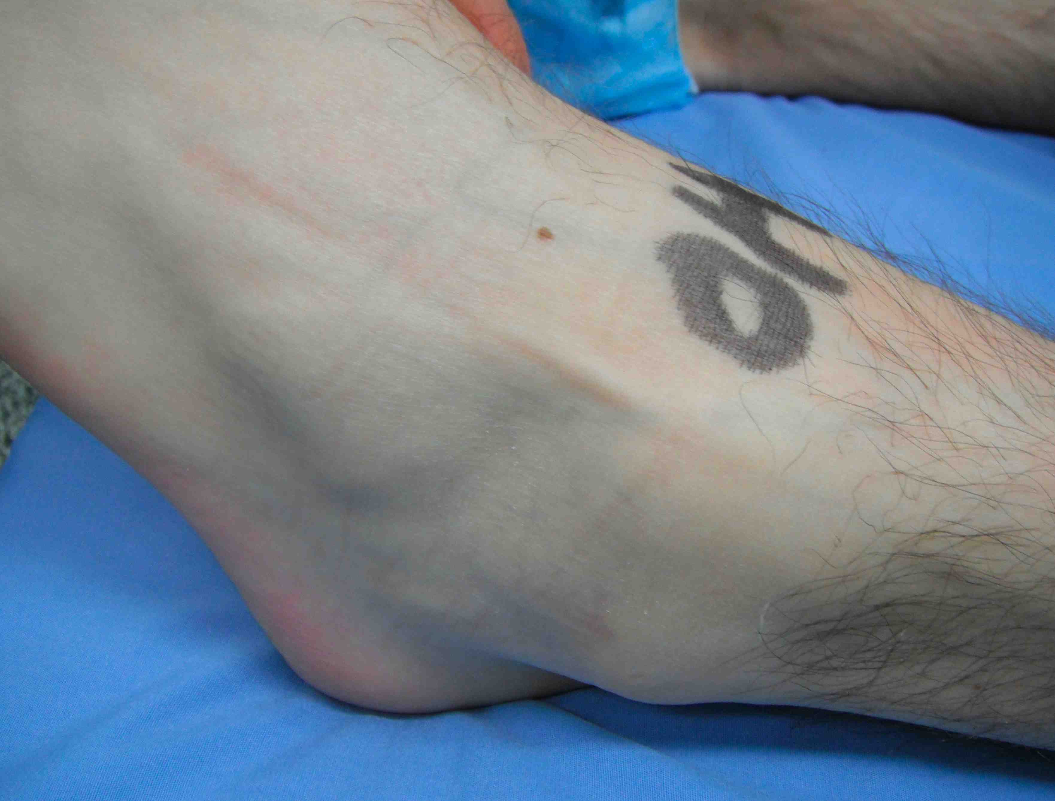 Ankle Superficial Peroneal Nerve